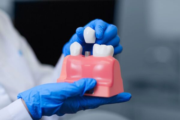Dental Implants in Riviera Beach – West Palm Beach Family Dental