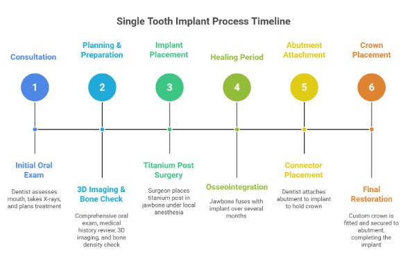 What Does the Single Tooth Implant Process Look Like?